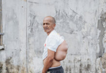 Farmer, 53, Happy to Sleep on His Back Again after Tumor Removal